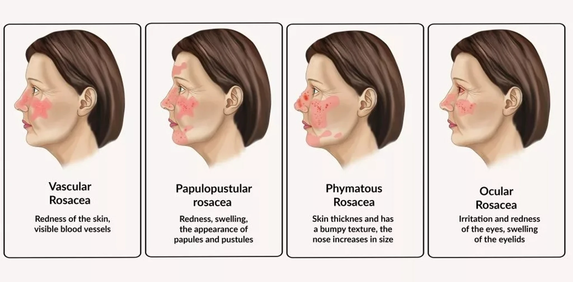 Trądzik różowaty i jego czynniki wyzwalające: szczegółowy przewodnik