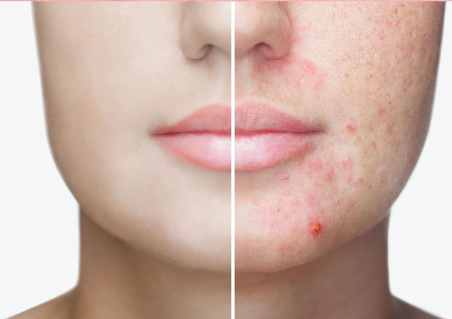 Komedogenność w kosmetykach: czy powinniśmy się niepokoić?