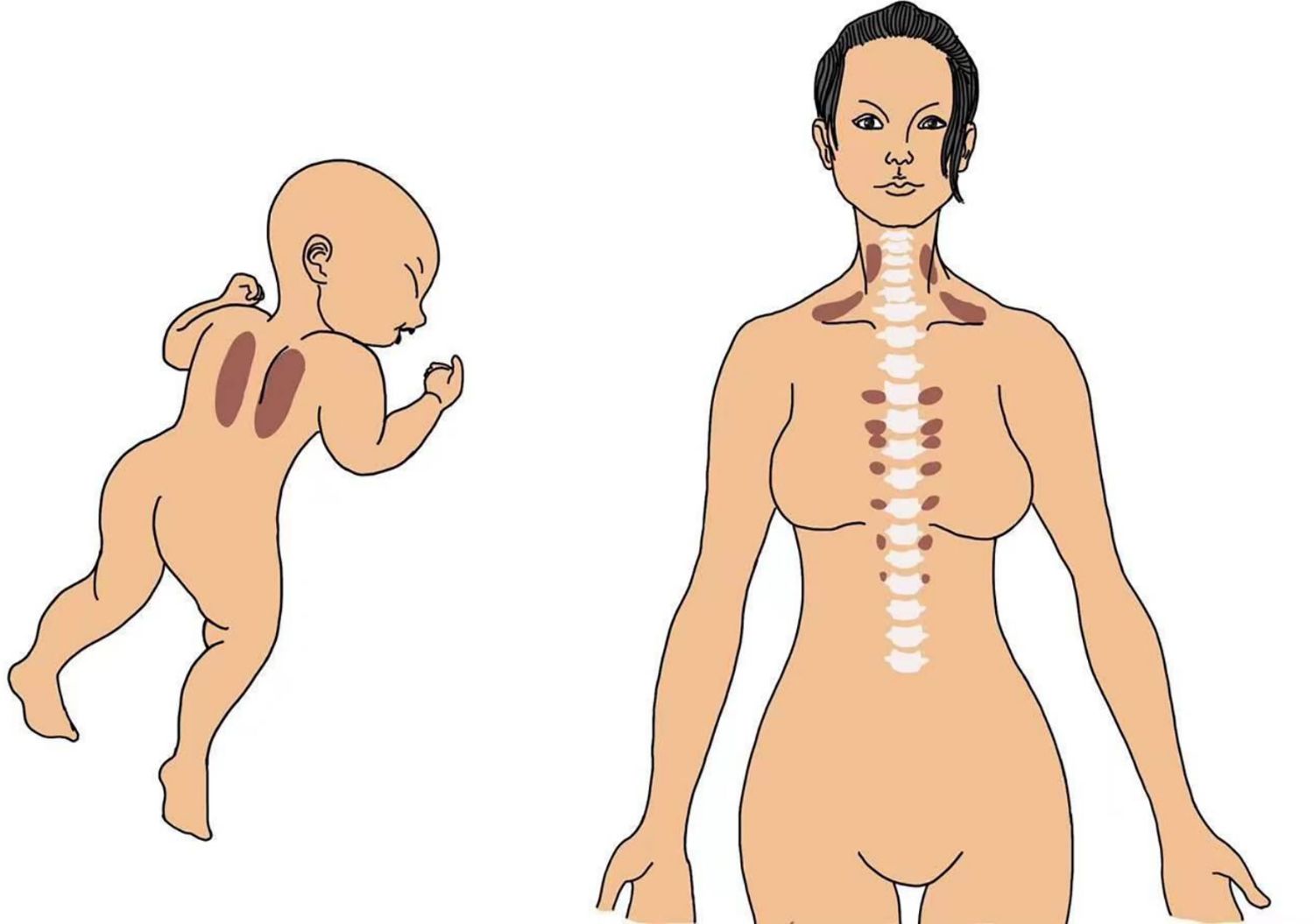 Etiologia cellulitu. Dlaczego występuje cellulit?