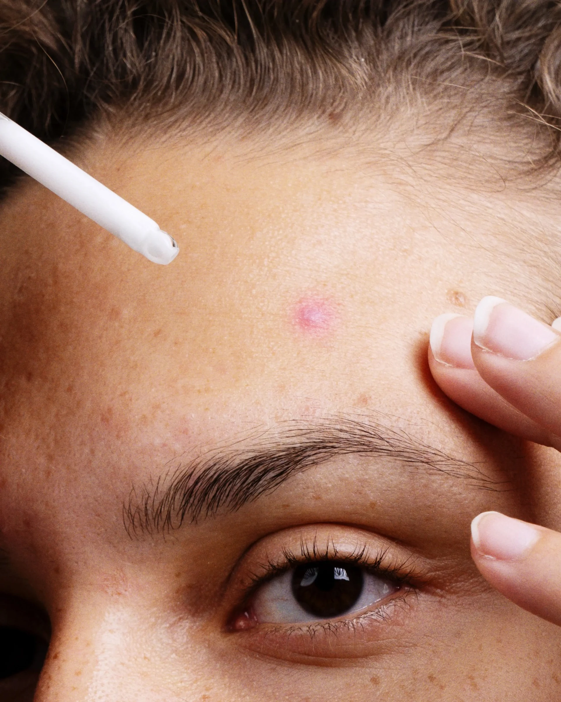 Czy niacynamid pomaga na trądzik?