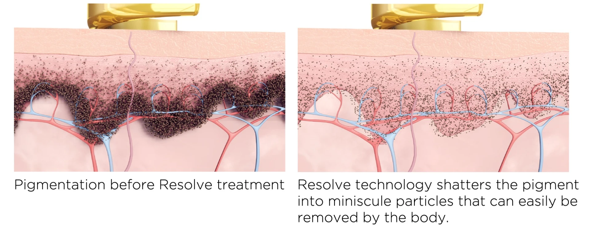 Jak leczyć plamy starcze na dłoniach?