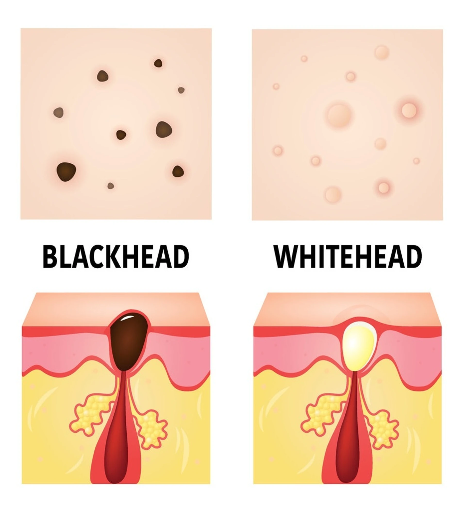 Zaskórniki: otwarte i zamknięte