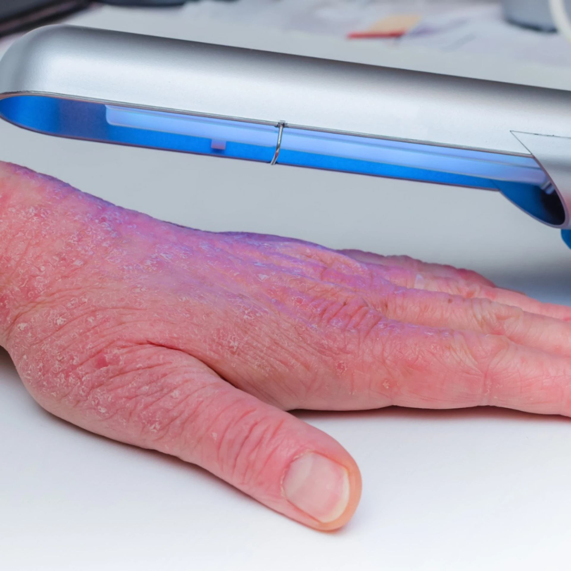 Alternatywne metody leczenia przewlekłego wyprysku rąk