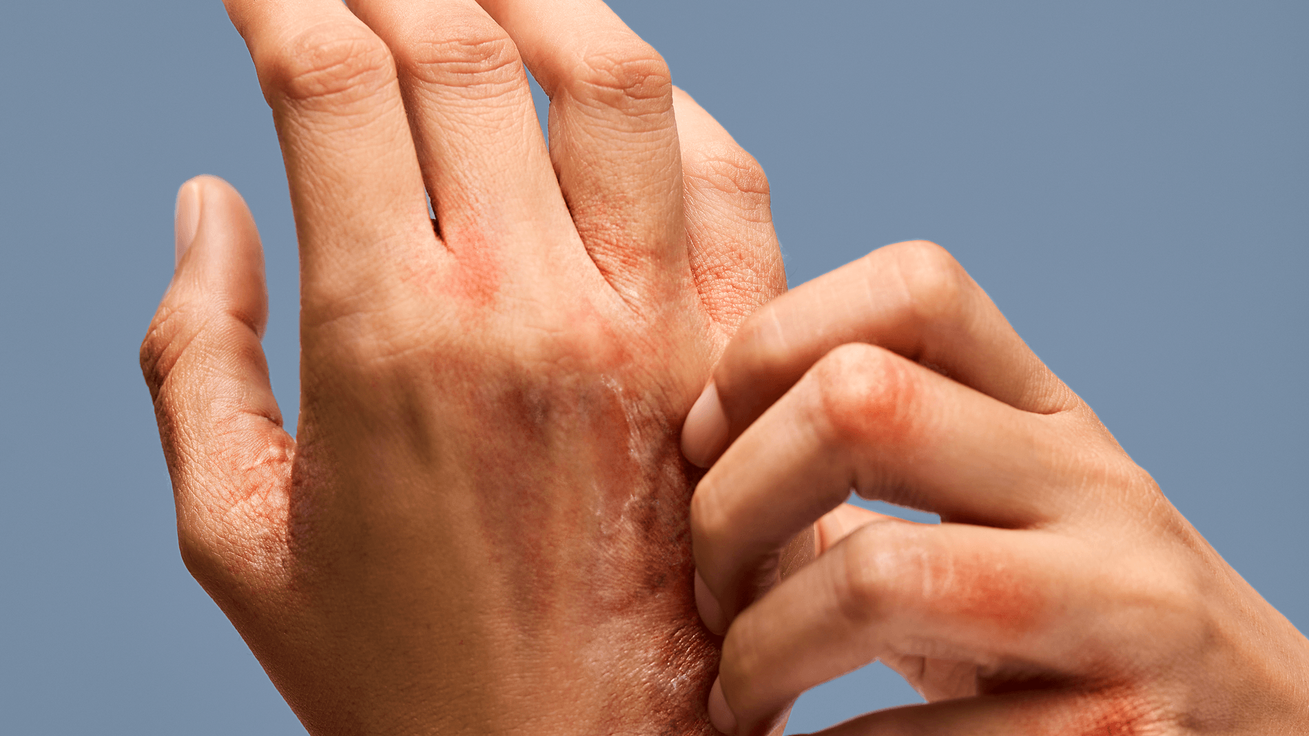 Alternatywne metody leczenia przewlekłego wyprysku rąk