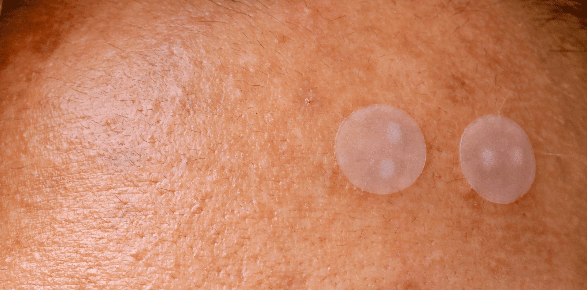 Plasterki na wypryski – jak skuteczne są naklejki na trądzik?