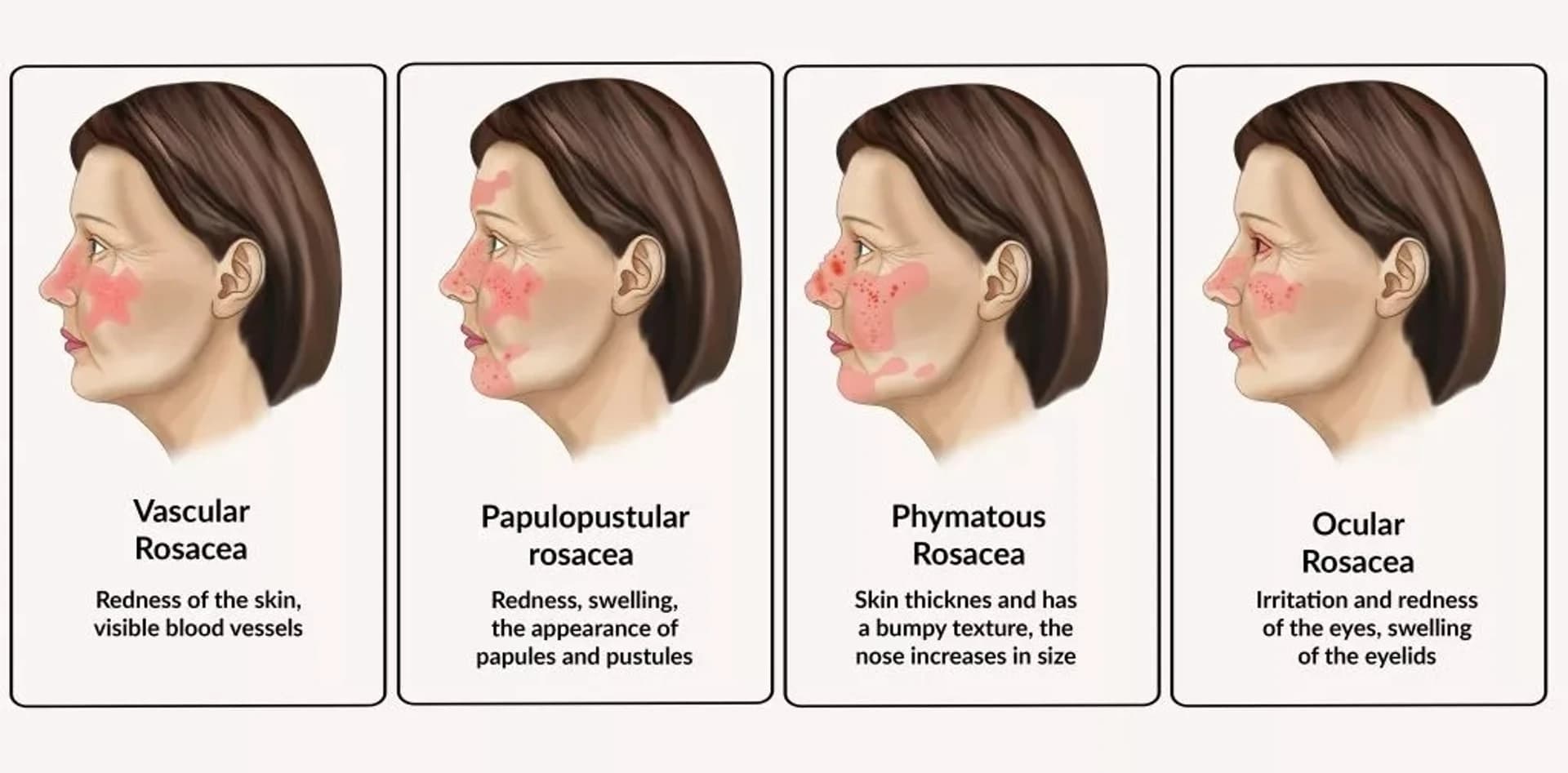 Trądzik różowaty i jego czynniki wyzwalające: szczegółowy przewodnik