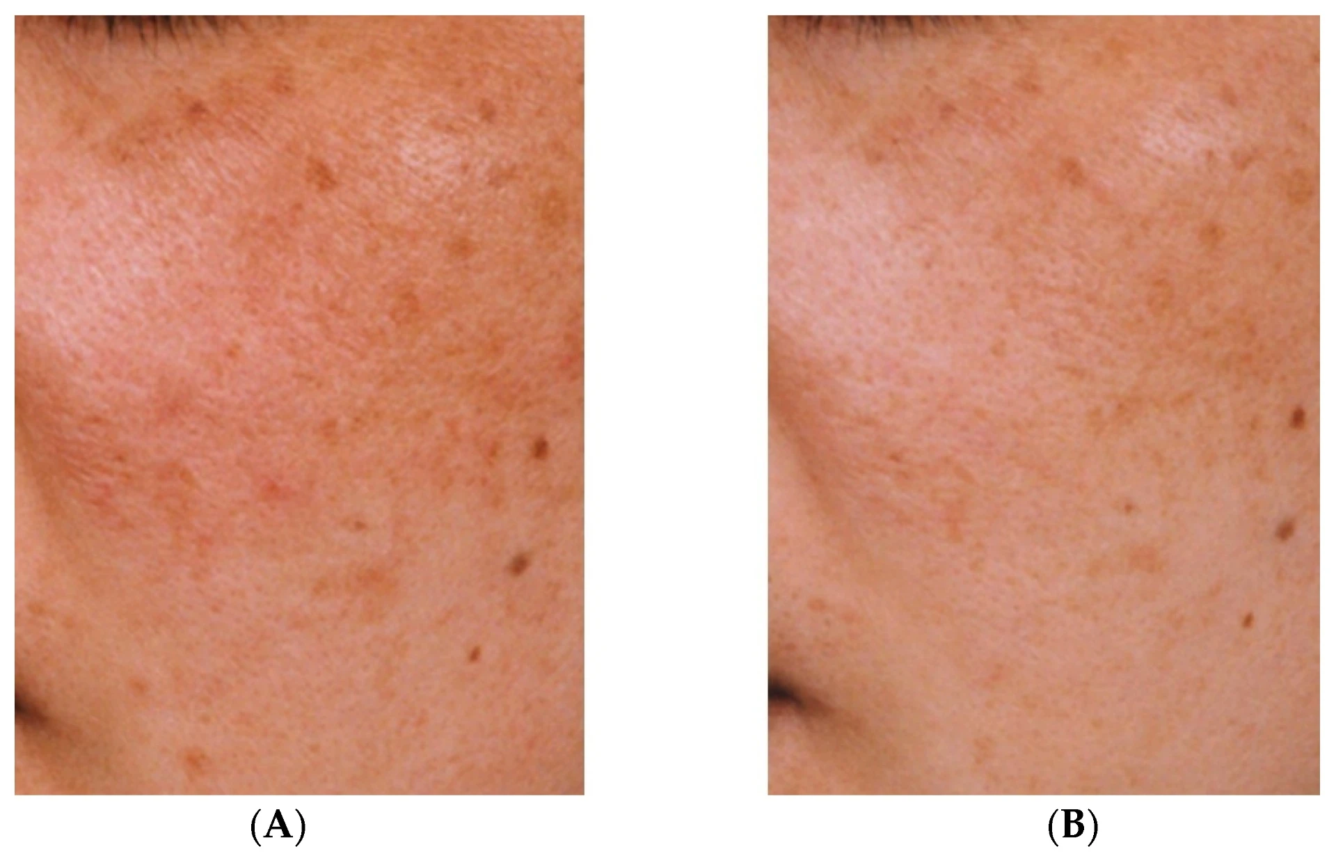 Kwas traneksamowy: skuteczny sposób w walce z hiperpigmentacją