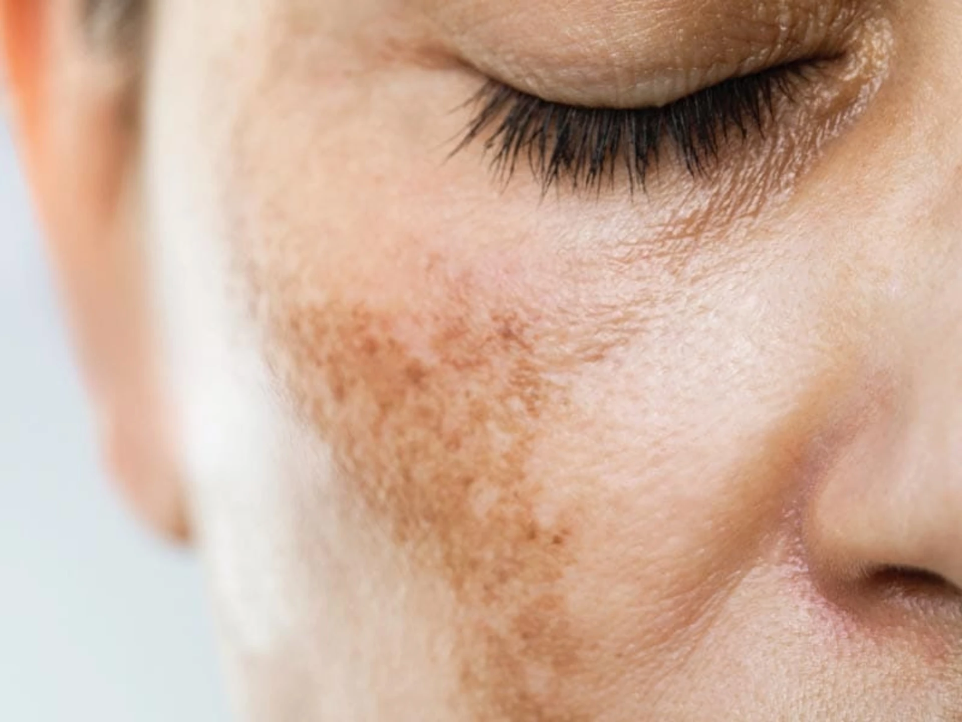 Top 9 składników na redukcję przebarwień