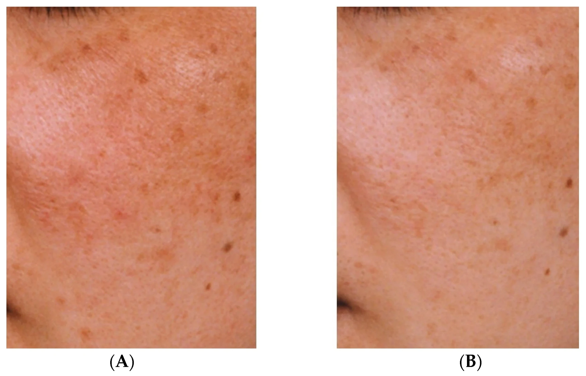 Kwas traneksamowy na melazmę: korzyści i skutki uboczne