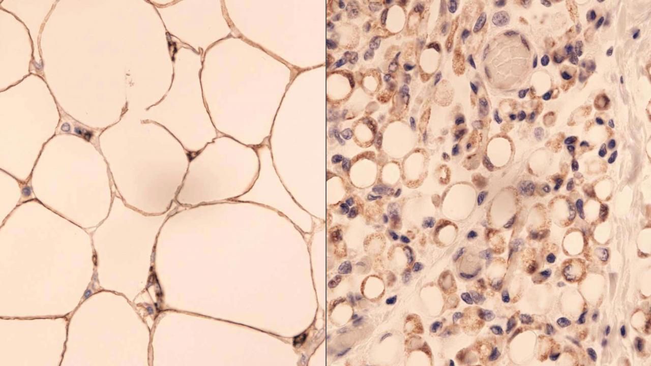 Etiologia cellulitu. Dlaczego występuje cellulit?