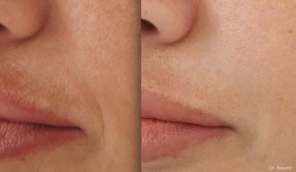 Recenzja kremu Expigment 4% — skuteczne rozwiązanie na plamy pigmentacyjne