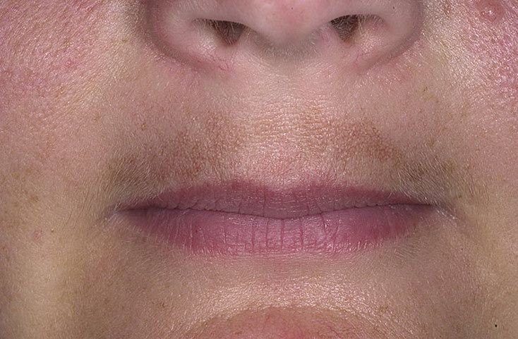 Recenzja kremu Expigment 4% — skuteczne rozwiązanie na plamy pigmentacyjne