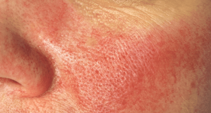 Trądzik różowaty (rosacea)