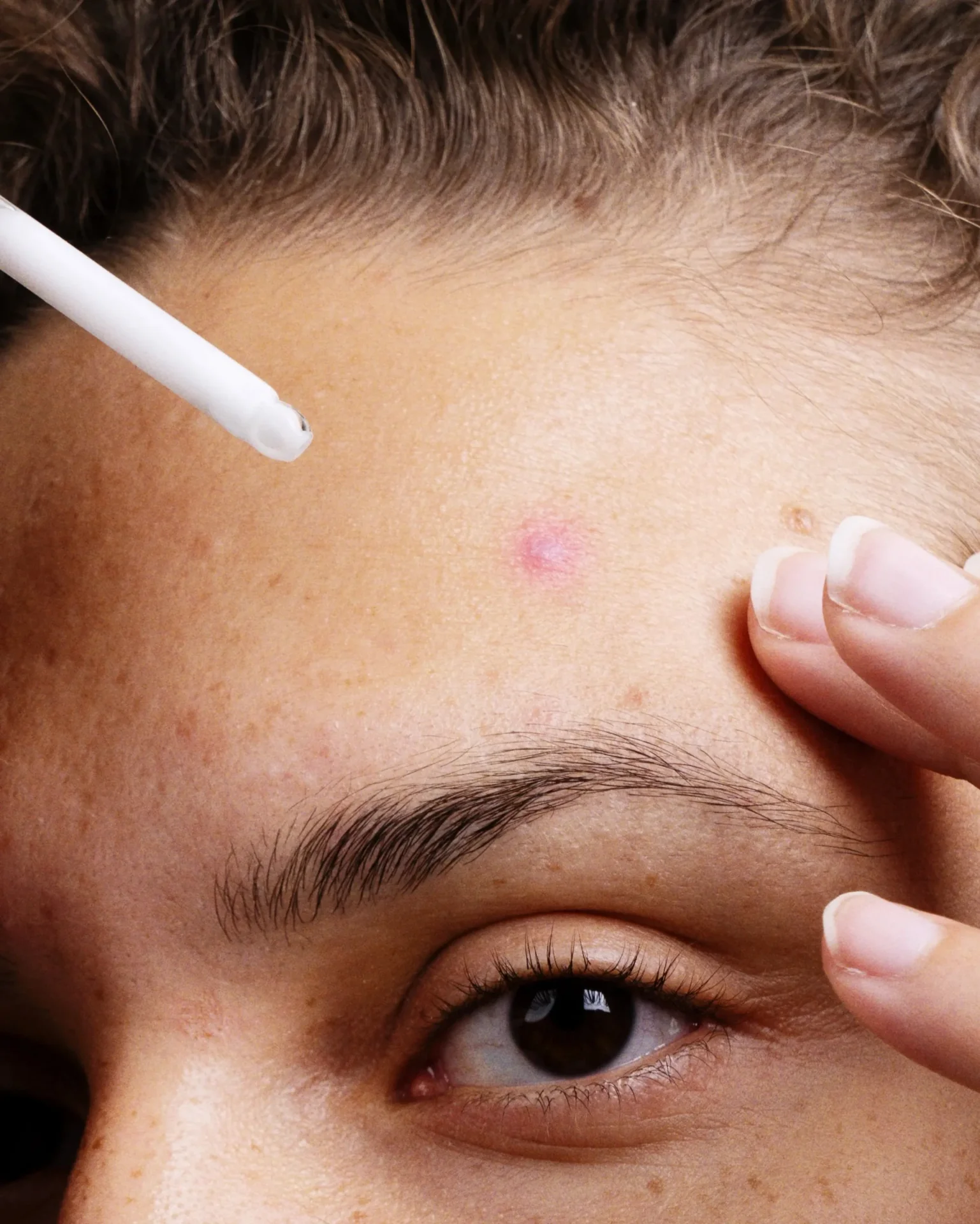 Czy niacynamid pomaga na trądzik?