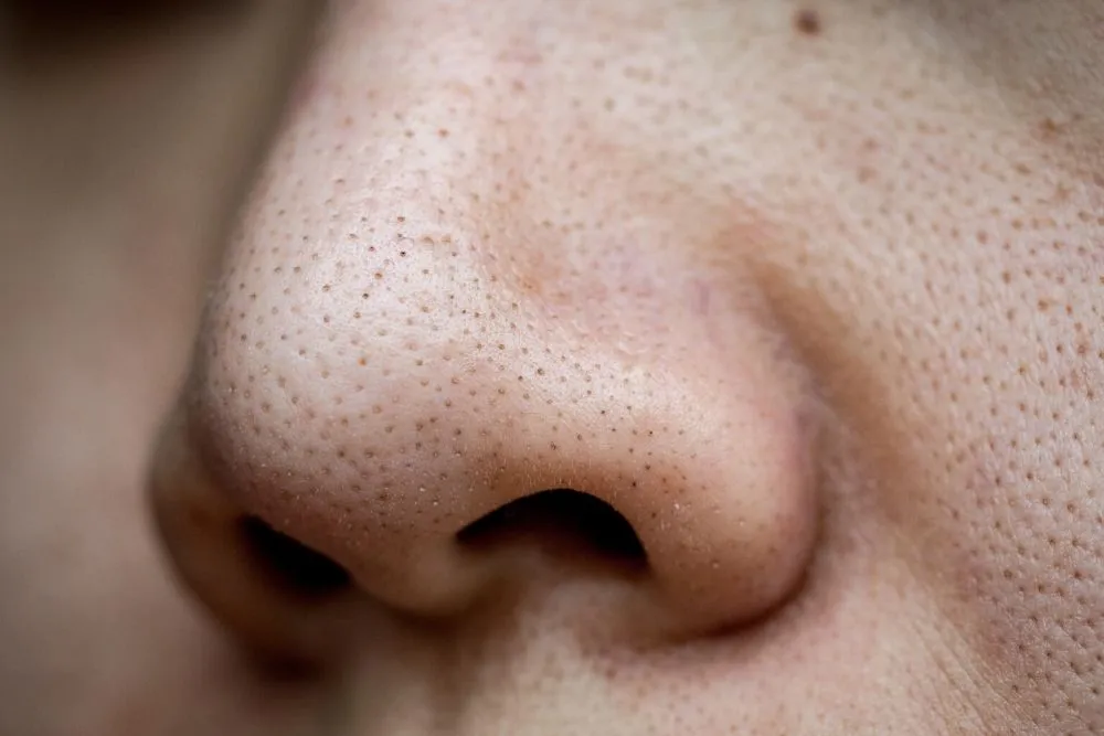 Główne przyczyny rozszerzonych porów